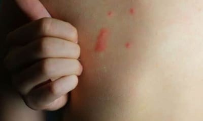 Le punture di pappataci sono caratterizzate da un'infiammazione locale nella zona colpita, accompagnata da prurito e gonfiore
